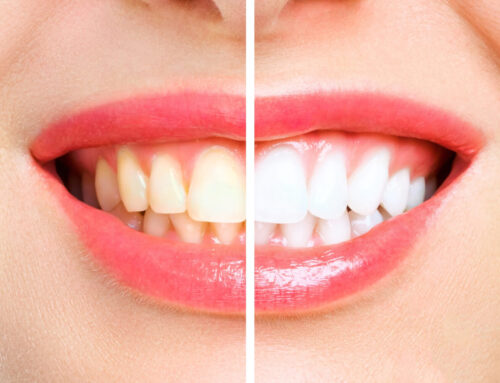 Izbeljivanje zuba – kako izgleda u praksi?